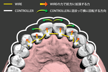 3Dガイドシステム矯正